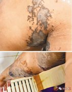 被镪水射中的港警：医生撕开人造植皮